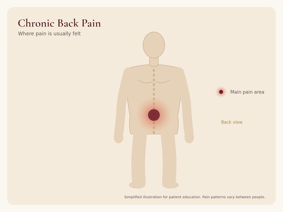 Chronic Back Pain: pain area Body diagram showing where chronic back pain pain is usually felt