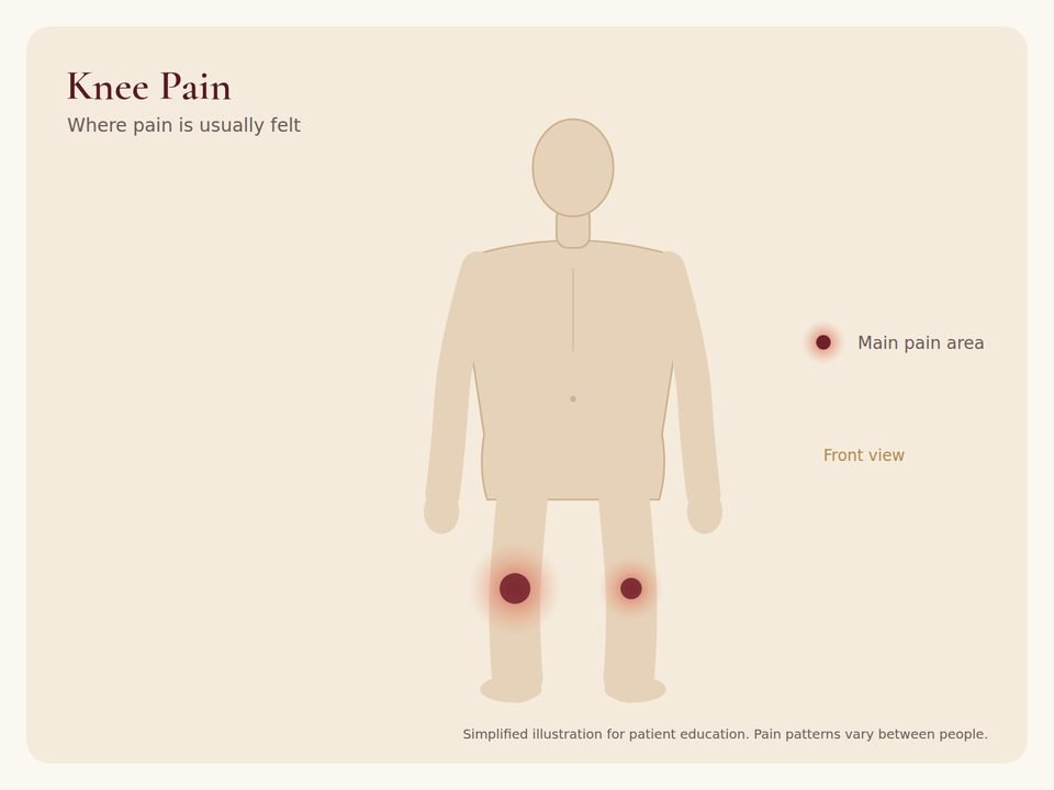 Knee Pain: pain area Body diagram showing where knee pain pain is usually felt