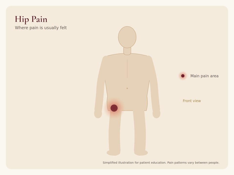 Hip Pain: pain area Body diagram showing where hip pain pain is usually felt