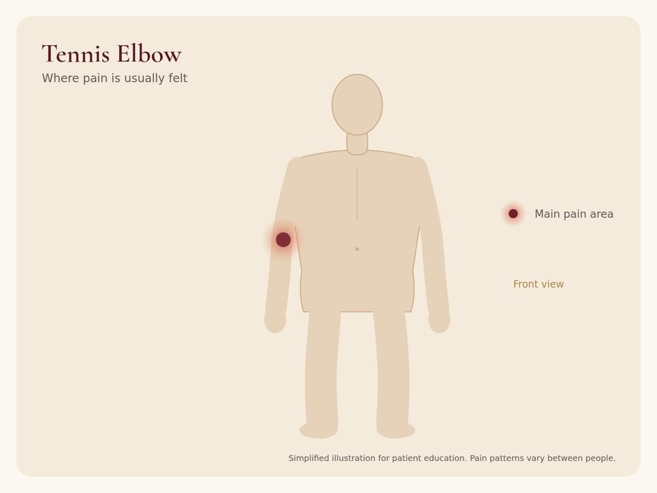 Body diagram showing where tennis elbow pain is usually felt