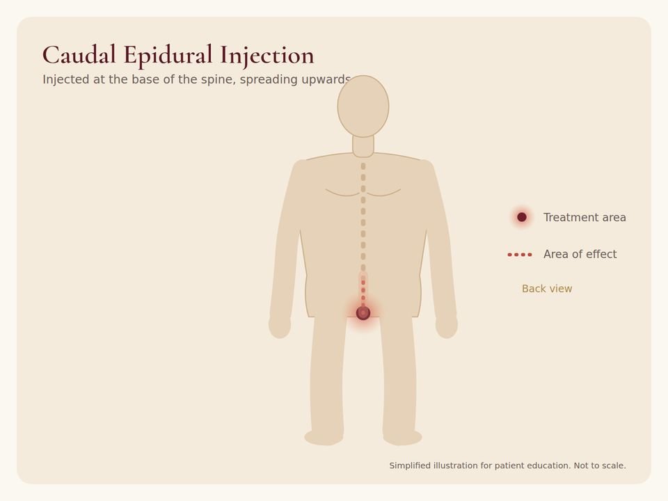 Caudal Epidural Injection: treatment area Body diagram showing the treatment area for Caudal Epidural Injection