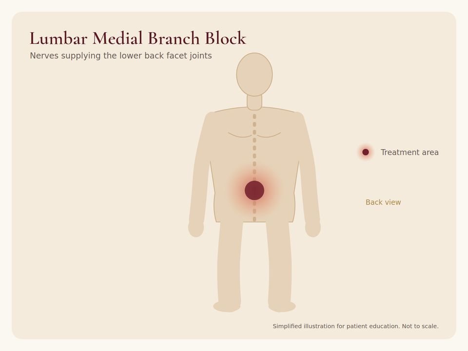 Body diagram showing the treatment area for Lumbar Medial Branch Block
