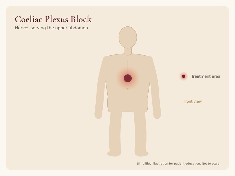 Coeliac Plexus Block: treatment area Body diagram showing the treatment area for Coeliac Plexus Block
