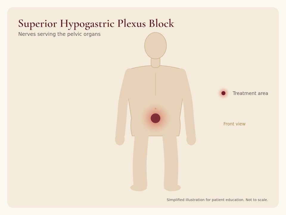 Body diagram showing the treatment area for Superior Hypogastric Plexus Block