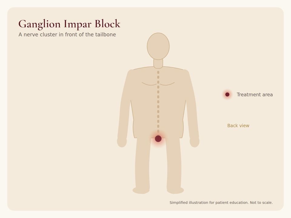Body diagram showing the treatment area for Ganglion Impar Block