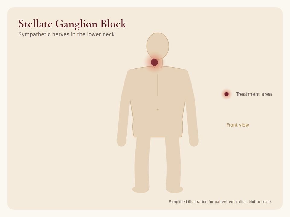Body diagram showing the treatment area for Stellate Ganglion Block