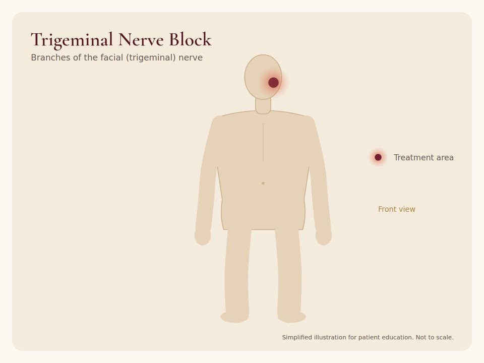 Body diagram showing the treatment area for Trigeminal Nerve Block