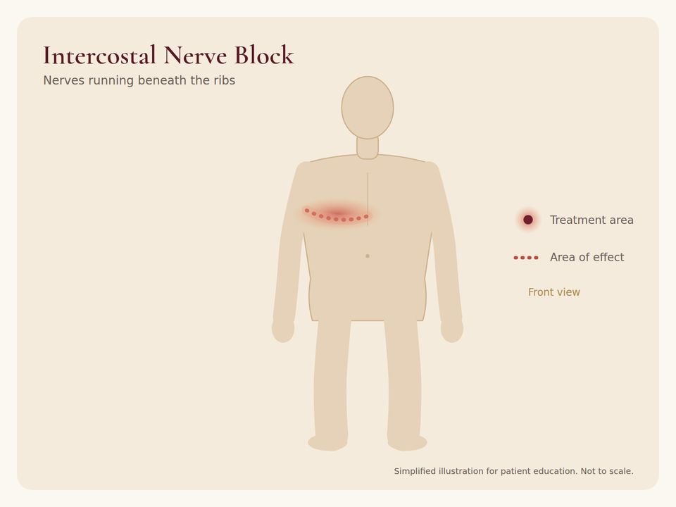Body diagram showing the treatment area for Intercostal Nerve Block