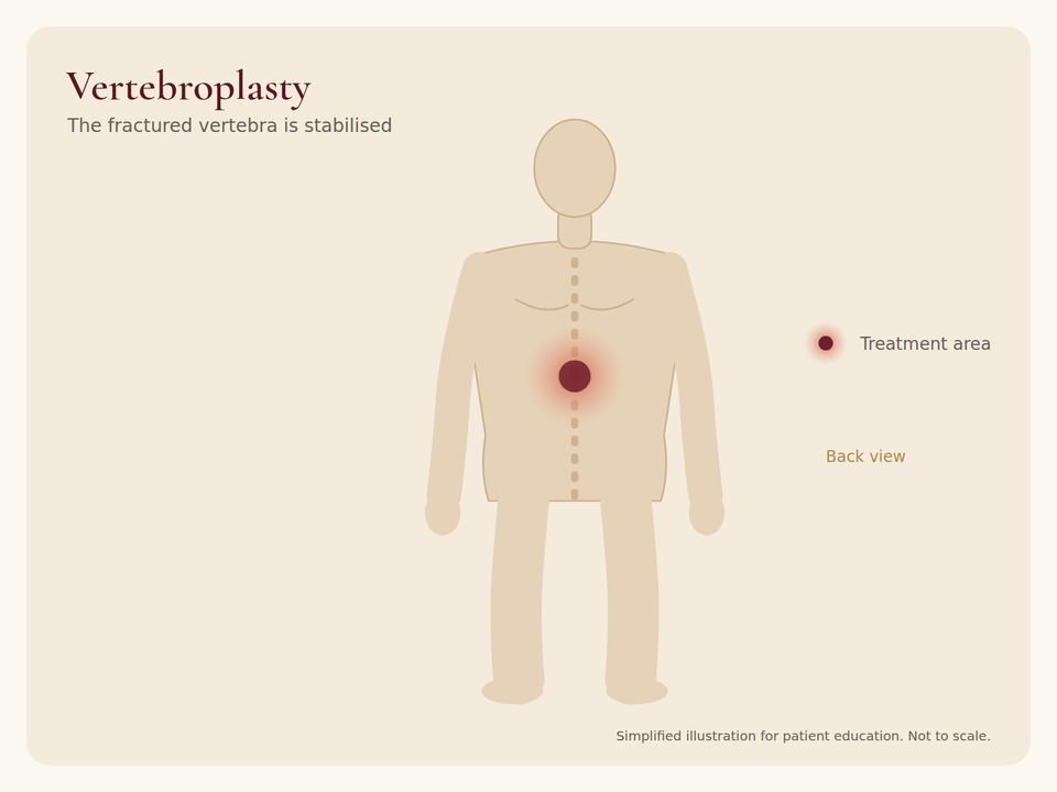 Body diagram showing the treatment area for Vertebroplasty