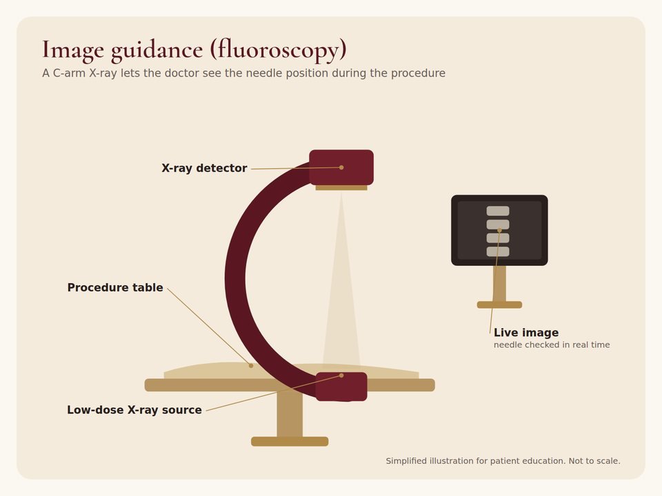 Illustration of a C-arm fluoroscopy machine and monitor used to guide pain procedures