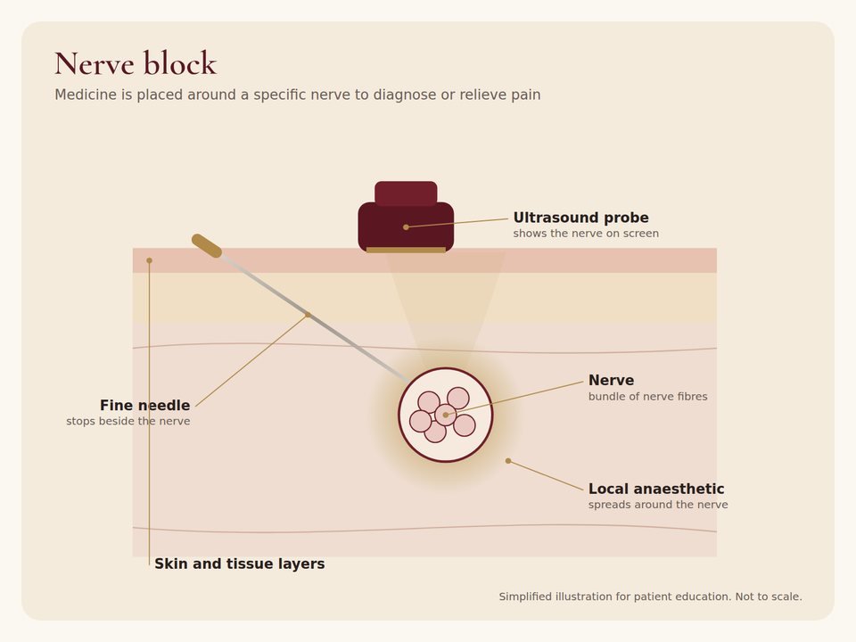 Illustration of an ultrasound-guided nerve block with local anaesthetic spreading around a nerve