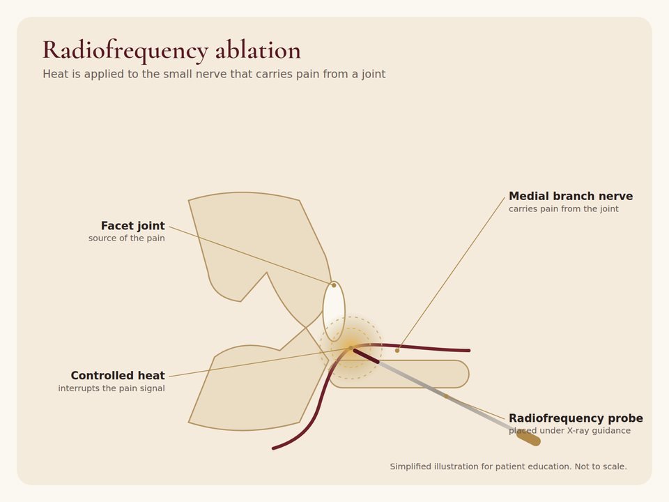 Radiofrequency ablation Illustration of radiofrequency ablation: a probe applying controlled heat to the medial branch nerve of a facet joint