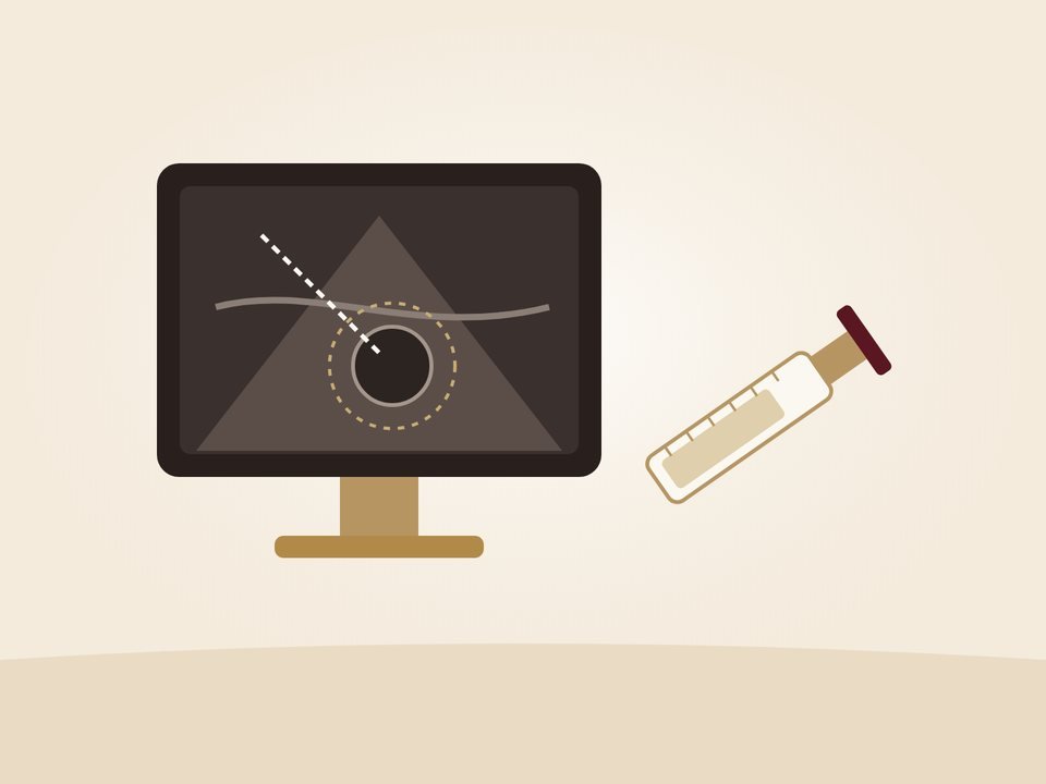 Illustration of an image-guided injection: an ultrasound screen showing the needle path to the target